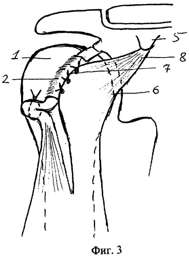 Способ хирургического лечения привычного вывиха плеча (патент 2283629)