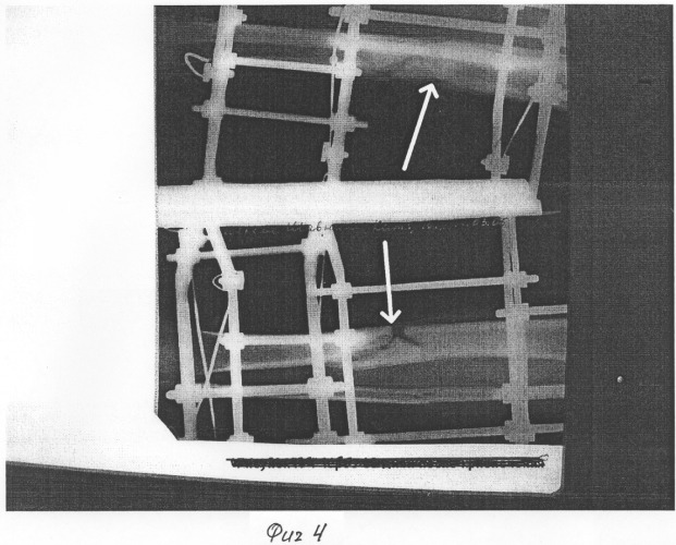 Способ лечения переломов длинных трубчатых костей (патент 2311155)