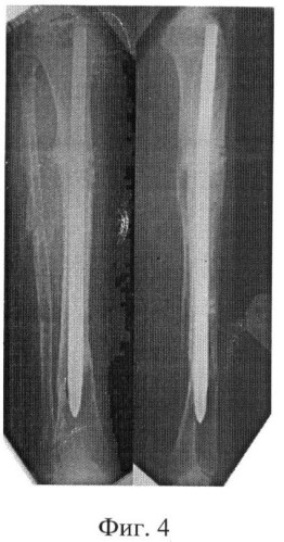 Способ лечения длительно срастающихся переломов и ложных суставов длинных костей (патент 2375006)