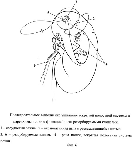 Способ одномоментного закрытия раны и полостной системы почки при лапароскопической резекции (патент 2532942)