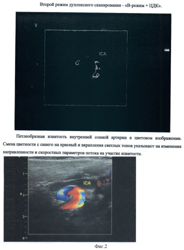 Способ определения риска микроэмболизации средней мозговой артерии у детей с патологической извитостью внутренней сонной артерии (патент 2421141)