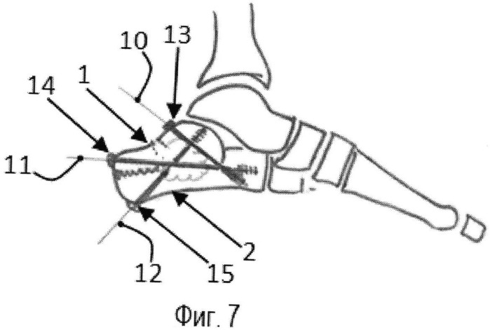 Способ оперативного лечения закрытых оскольчатых языкообразных переломов пяточной кости (патент 2520800)