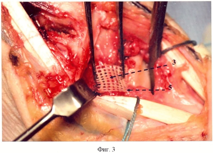 Способ фиксации васкуляризированного костного трансплантата на костях запястья (патент 2489109)