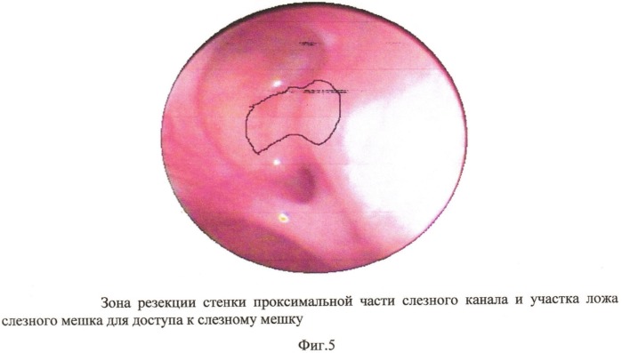 Способ хирургического лечения хронического дакриоцистита (патент 2532014)