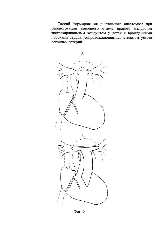 Способ формирования дистального анастомоза при реконструкции выводного отдела правого желудочка экстракардиальным кондуитом у детей с врожденными пороками сердца, сопровождающимися стенозом устьев легочных артерий (патент 2639030)