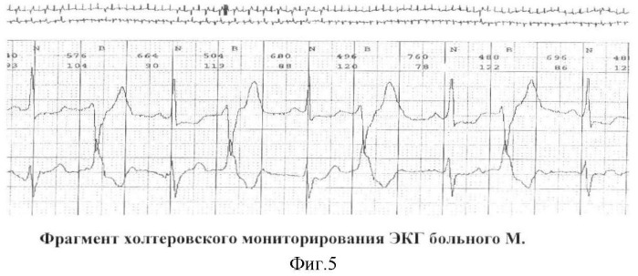 Способ прогнозирования течения ишемической болезни сердца (патент 2391044)