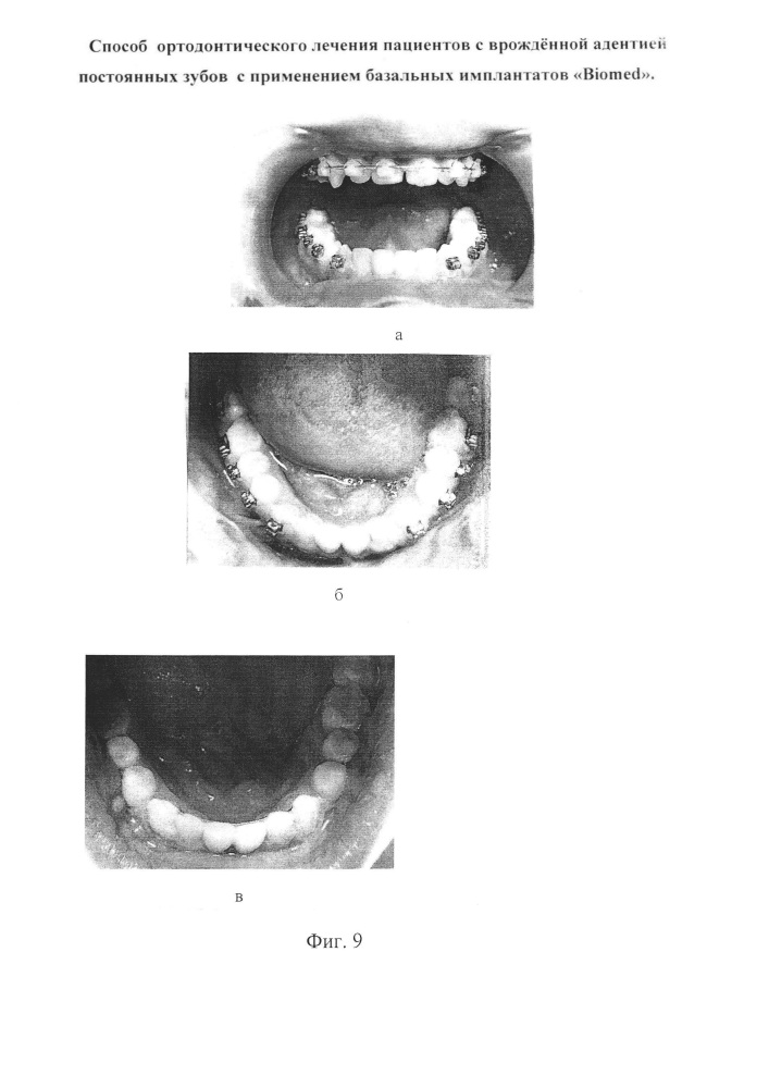 Способ ортодонтического лечения пациентов с врождённой адентией постоянных зубов с применением базальных имплантатов "biomed" (патент 2638286)