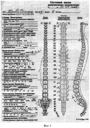 Способ оценки результатов лечения сколиозов i и ii степени с использованием индекса орла-артемова (ioa) (патент 2342075)