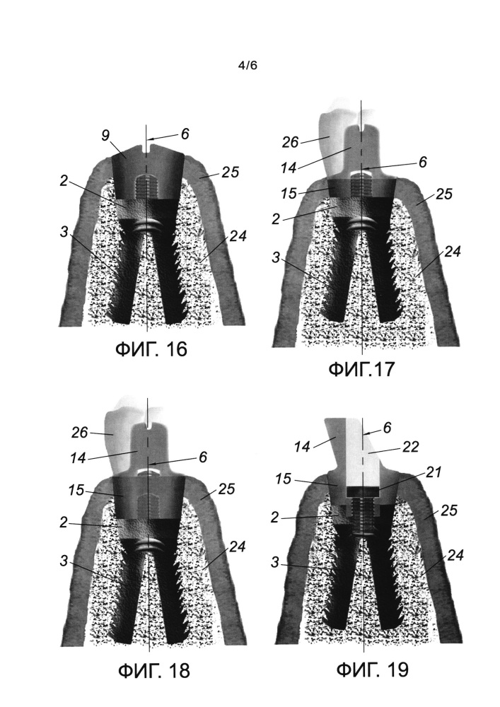 Зубной имплантат и комплект для дентальной имплантации (патент 2661019)