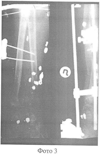 Способ хирургического лечения сегментарных дефектов диафизов костей предплечья (патент 2358677)