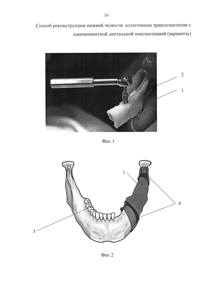 Способ реконструкции нижней челюсти аллогенным трансплантатом с одномоментной дентальной имплантацией (варианты) (патент 2595087)