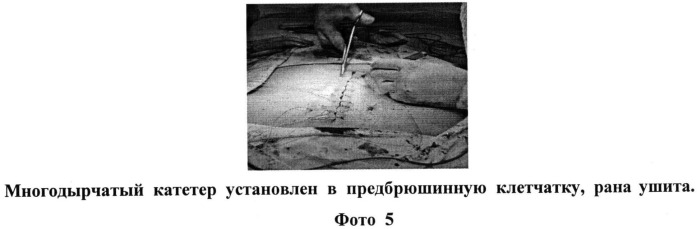 Способ преперитонеальной блокады после герниопластики срединных послеоперационных вентральных грыж (патент 2529412)