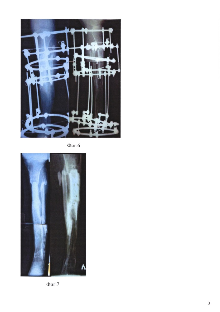 Способ замещения посттравматического дефекта большеберцовой кости (патент 2626146)