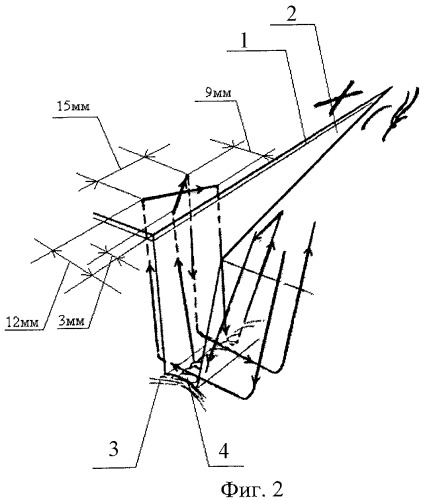 Способ закрытия раневого дефекта после радикального иссечения эпителиального копчикового хода по кривоносову-брежневу (патент 2464943)