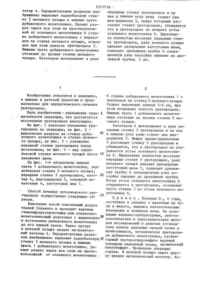 Способ лечения эктопического уретероцеле добавочного мочеточника у детей (патент 1311716)