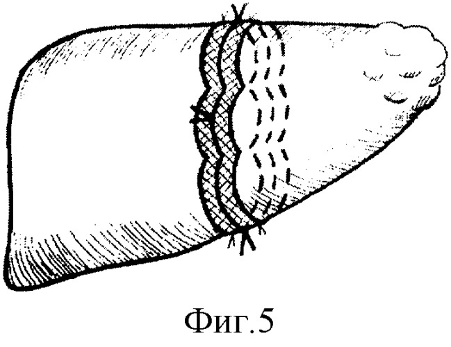Способ резекции печени (патент 2278617)