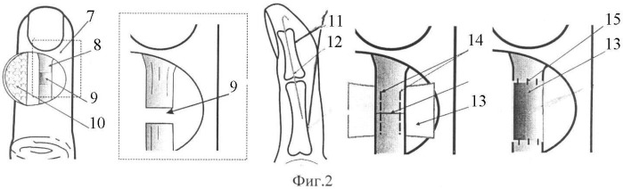 Реконструктивный способ восстановления сухожилия (варианты) (патент 2331381)