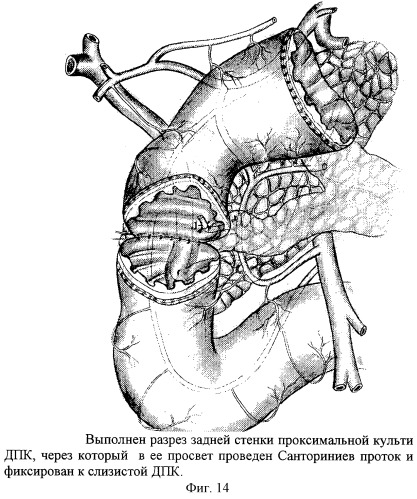Способ хирургического лечения низких осложненных пенетрацией и кровотечением гигантских дуоденальных язв (патент 2259169)