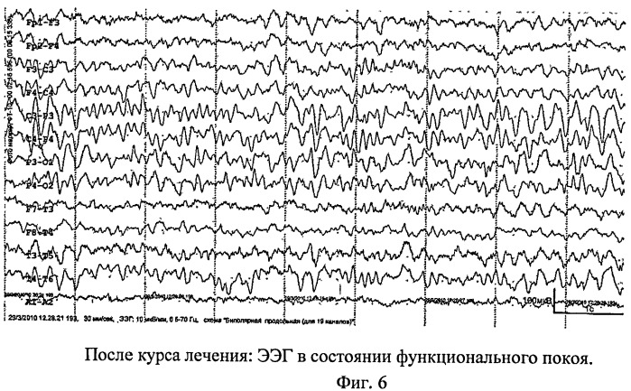 Способ лечения гиперкинетического расстройства у детей (патент 2476250)