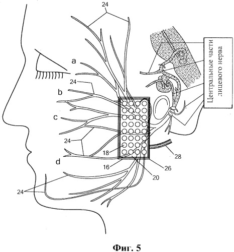Система и способ стимуляции лицевого нерва (патент 2511082)