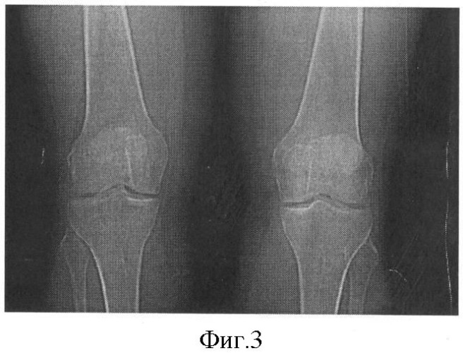 Способ определения степени изменения губчатой кости при деформирующем артрозе коленного сустава (патент 2487669)