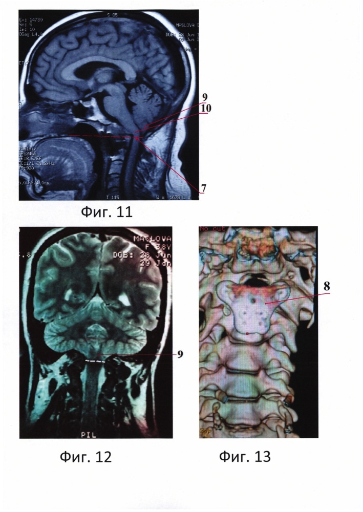 Способ лечения инвагинированного зубовидного отростка с2 позвонка, сочетающегося с мальформацией киари i типа (патент 2620888)