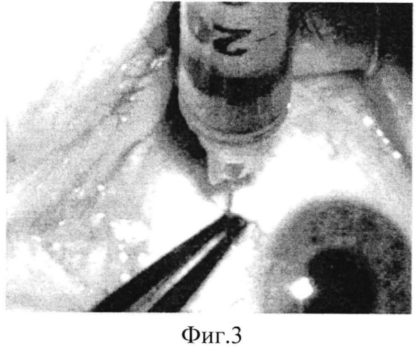 Способ интравитреального введения лекарственных препаратов в офтальмологии (патент 2581219)