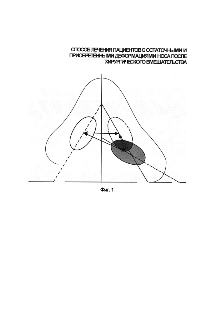 Способ лечения пациентов после хирургического вмешательства, выполненного по поводу остаточных и приобретённых деформаций носа (патент 2630130)
