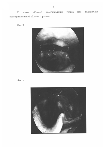 Способ восстановления голоса при пахидермии межчерпаловидной области гортани (патент 2591762)