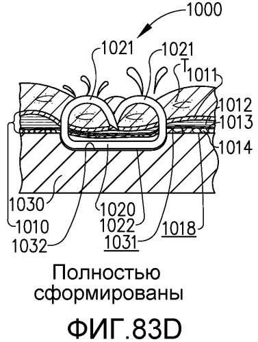 Имплантируемая кассета с крепежными элементами, имеющая неравномерную конструкцию (патент 2574370)