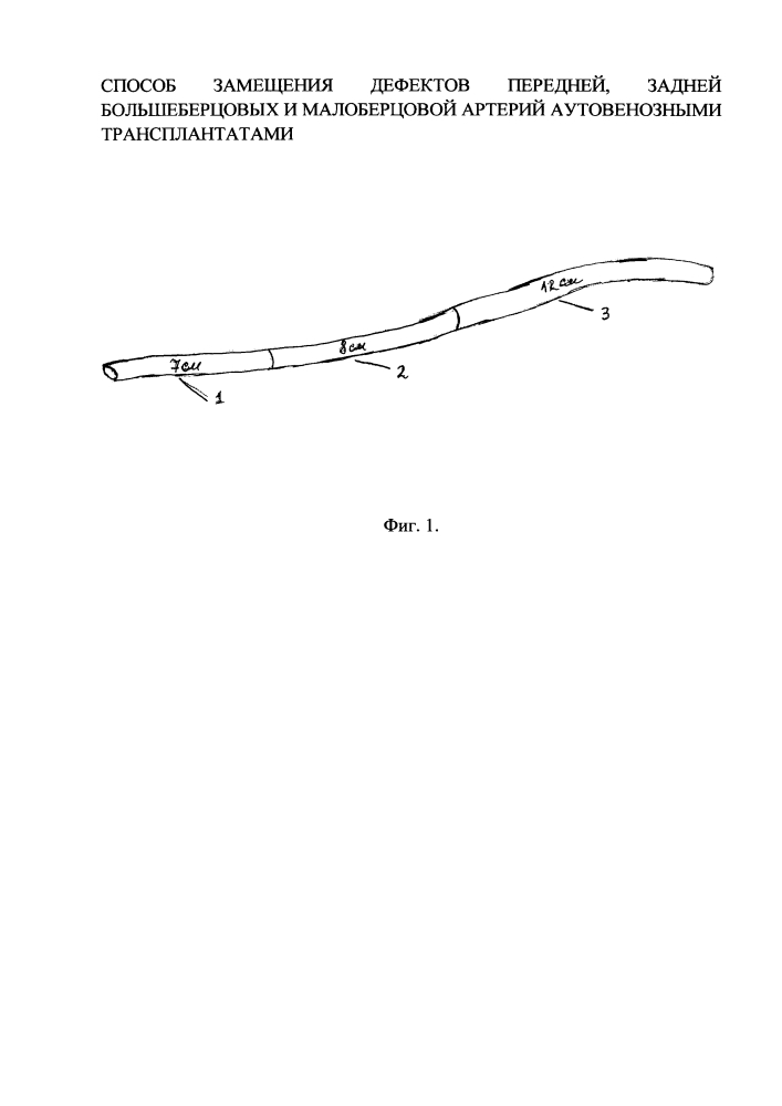Способ замещения дефектов передней, задней большеберцовых и малоберцовой артерий аутовенозными трансплантатами (патент 2644289)