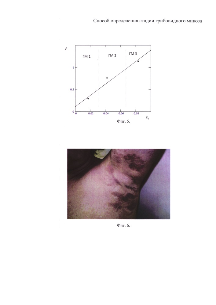 Способ определения стадии грибовидного микоза (патент 2639448)
