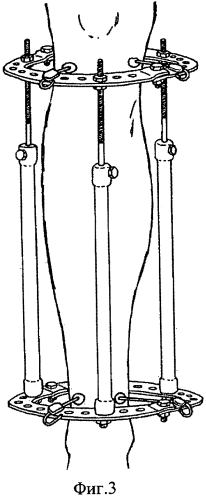 Устройство для внеочагового остеосинтеза открытых переломов голени (патент 2572300)