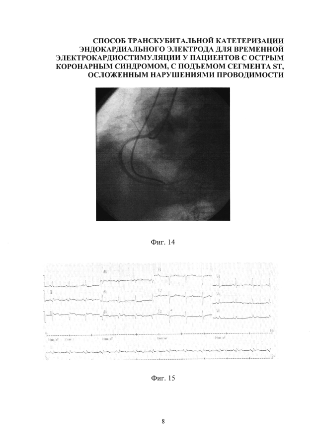 Способ катетеризации сердца для установки эндокардиального электрода для временной электрокардиостимуляции у пациентов с острым коронарным синдромом, с подъемом сегмента st, осложенным нарушениями проводимости (варианты) (патент 2594243)