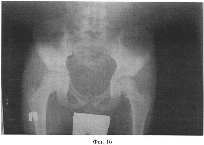Способ лечения сочетанной деформации таза и позвоночника у детей (патент 2423095)