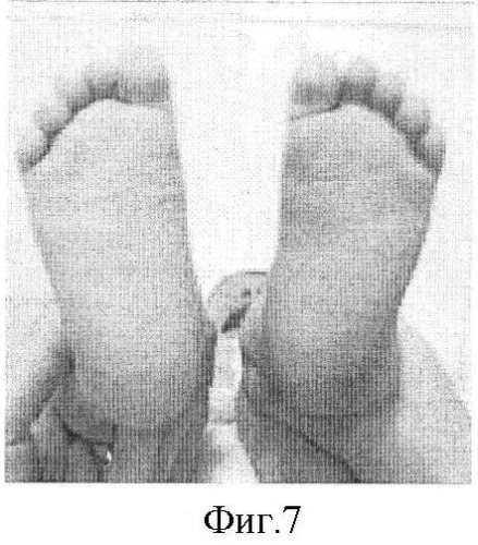 Способ лечения врожденной косолапости у детей первого года жизни (патент 2419405)