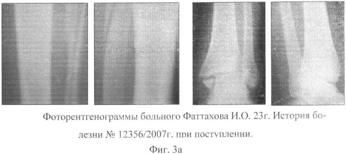 Способ оперативного лечения подголовчатых переломов малоберцовой кости при переломовывихах в голеностопном суставе (патент 2369341)