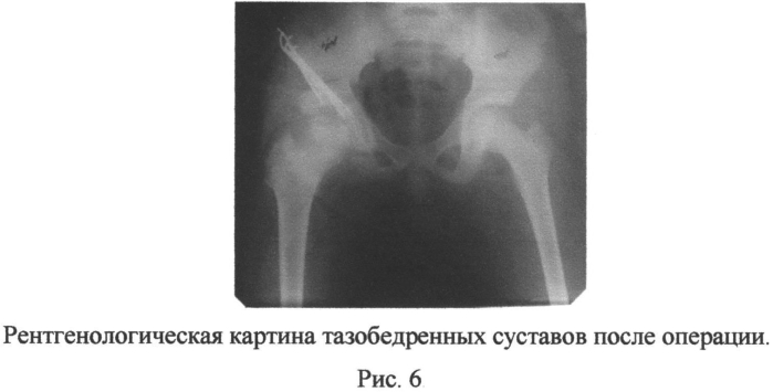 Способ выполнения периацетабулярной тройной остеотомии таза у подростков (патент 2556788)