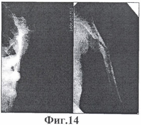 Способ несвободной костной пластики для лечения ложных суставов в верхней трети плечевой кости (патент 2401077)