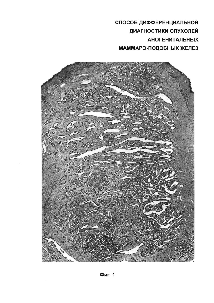 Способ дифференциальной диагностики опухолей аногенитальных маммароподобных желез (патент 2626123)