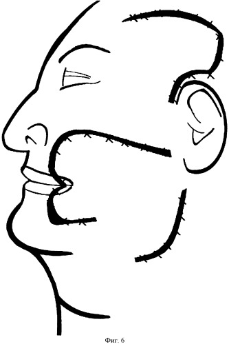 Способ пластики обширного сквозного дефекта мягких тканей щеки, угла рта, фрагментов верхней и нижней губы (патент 2489096)