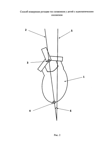 Способ измерения ротации тел позвонков у детей с идиопатическим сколиозом (патент 2587035)