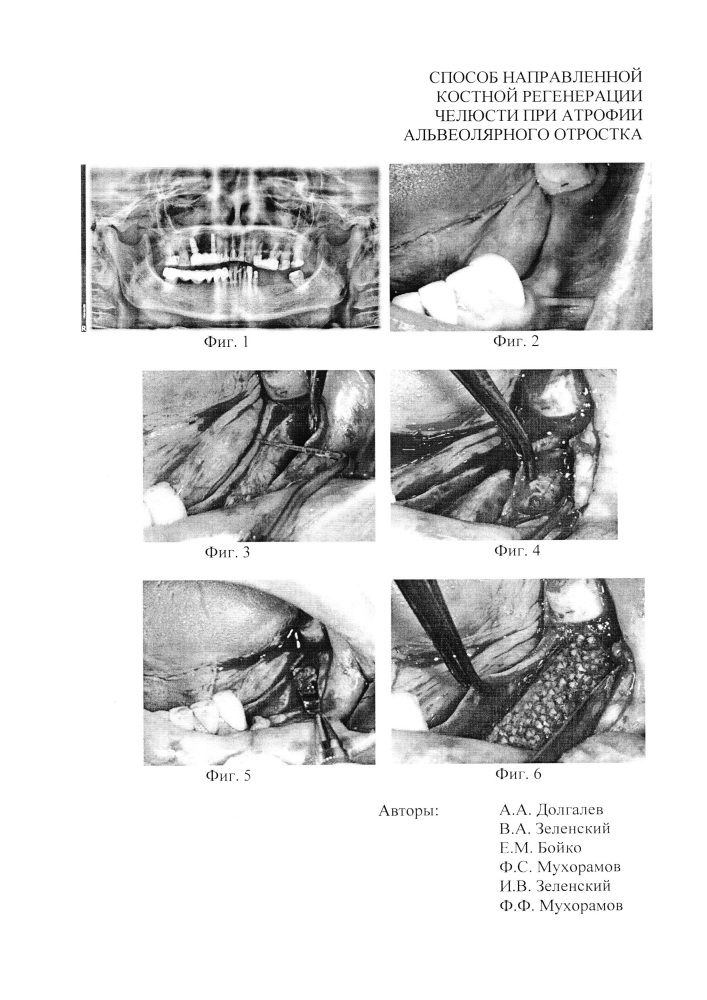 Способ направленной костной регенерации челюсти при атрофии альвеолярного отростка (патент 2648861)