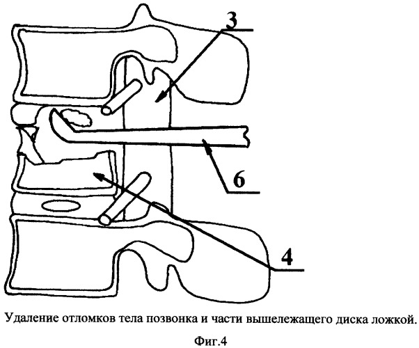 Способ переднего транспедикулярного спондилодеза (патент 2331378)