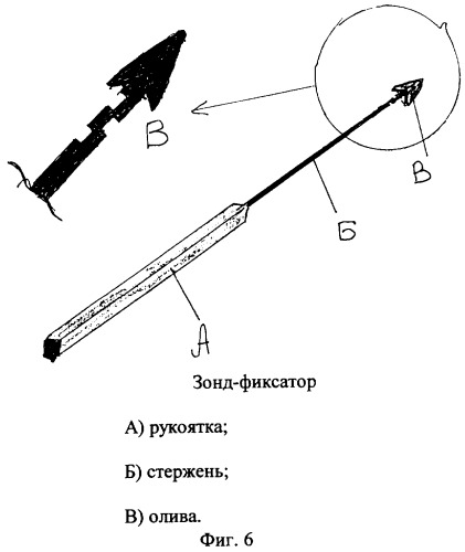 Способ хирургической коррекции сложных параректальных свищей (патент 2290881)