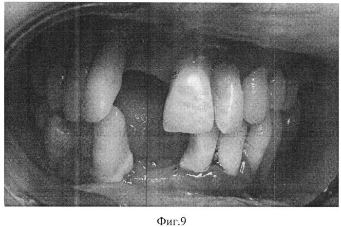 Способ восстановления тканей зубочелюстной системы (патент 2551312)