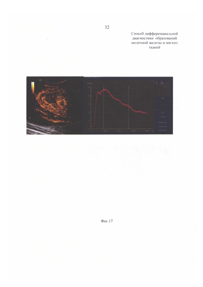 Способ дифференциальной диагностики образований молочной железы и мягких тканей (патент 2634783)