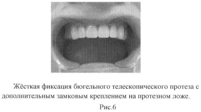 Способ изготовления дополнительных замковых креплений для бюгельных телескопических протезов (патент 2463994)