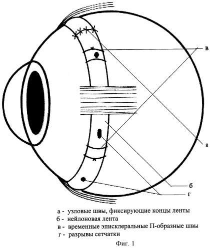 Способ лечения регматогенной отслойки сетчатки (патент 2253421)