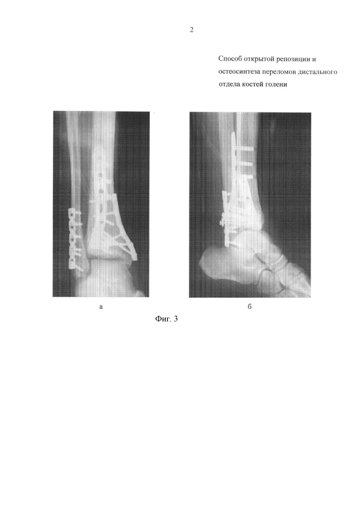 Способ открытой репозиции и остеосинтеза переломов дистального отдела костей голени (патент 2623298)